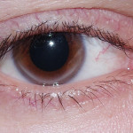 Arcus lipoides 06