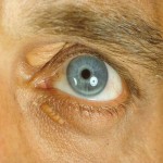 Arcus lipoides and xanthelasma palp.