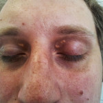 Xanthelasma palpebrarum 01
