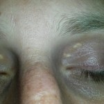 Xanthelasma palpebrarum 02