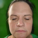 Xanthelasma palpebrarum 03
