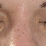 Xanthelasma palpebrarum 04